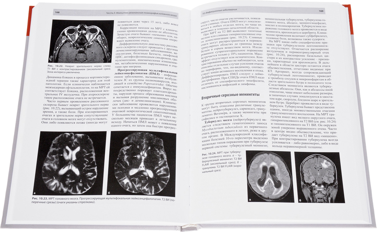 фото Магнитно-резонансная томография при заболеваниях и травмах центральной нервной системы