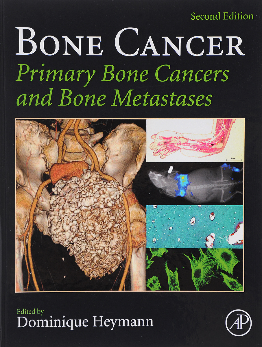 фото Bone Cancer: Primary Bone Cancers and Bone Metastases Academic press