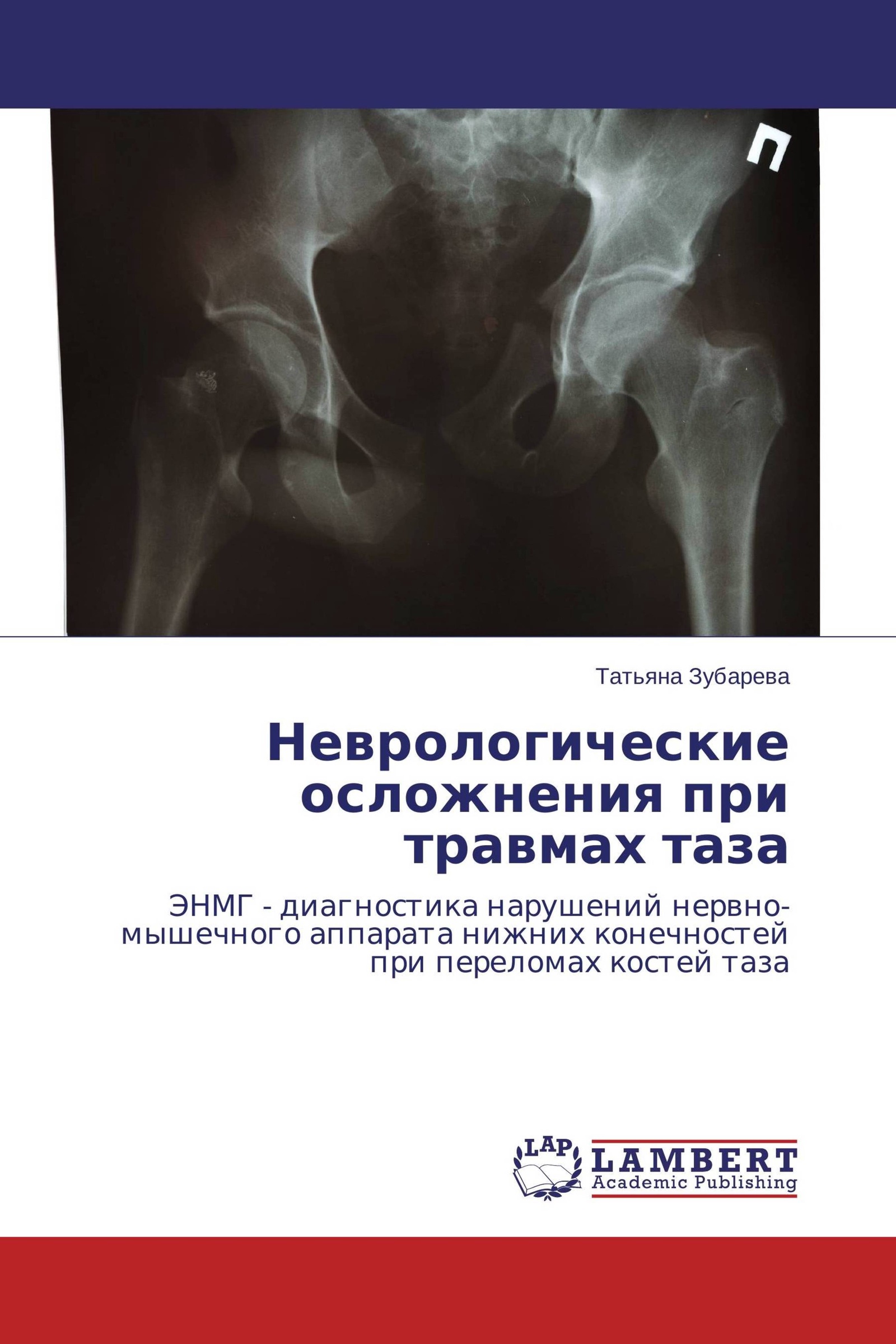 Ушиб таза код. Осложнения повреждения таза. неврологические осложнения.