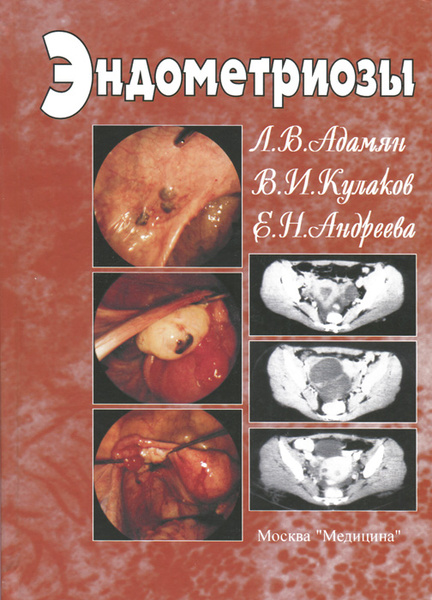 Эндометриозы | Адамян Лейла Владимировна, Кулаков Владимир Иванович ...