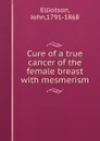 Cure of a true cancer of the female breast with mesmerism - John Elliotson