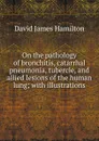 On the pathology of bronchitis, catarrhal pneumonia, tubercle, and allied lesions of the human lung; with illustrations - David James Hamilton