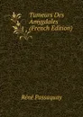 Tumeurs Des Amygdales (French Edition) - Réné Passaquay