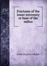 Fractures of the lower extremity or base of the radius - Lewis Stephen Pilcher