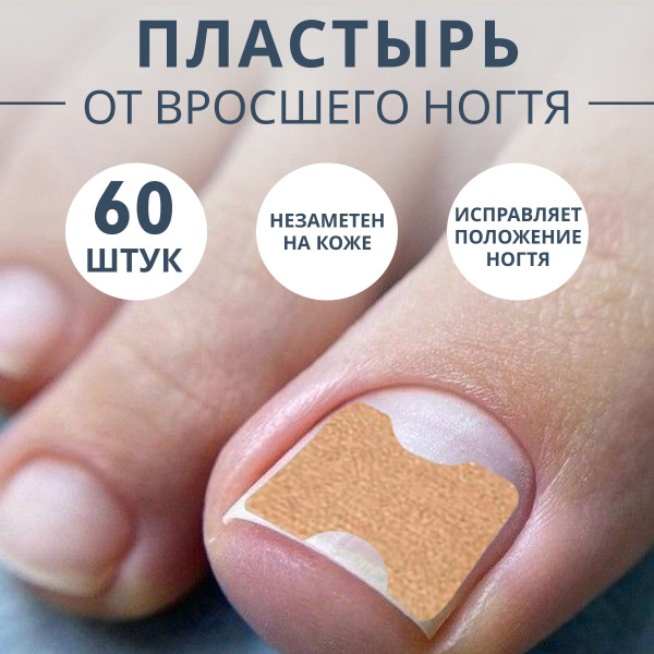 Пластырь-корректор от вросшего ногтя / наклейка-пластина на ноготь ...