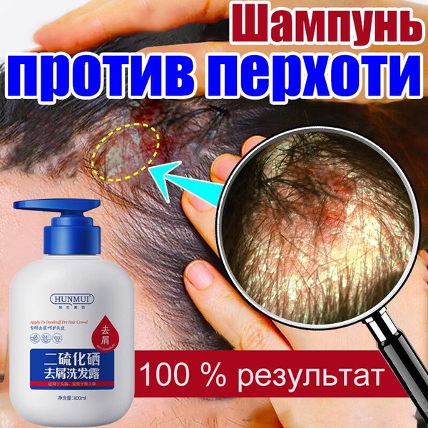 Интенсивный шампунь против перхоти, против себореи, псориаза, с селеном ...