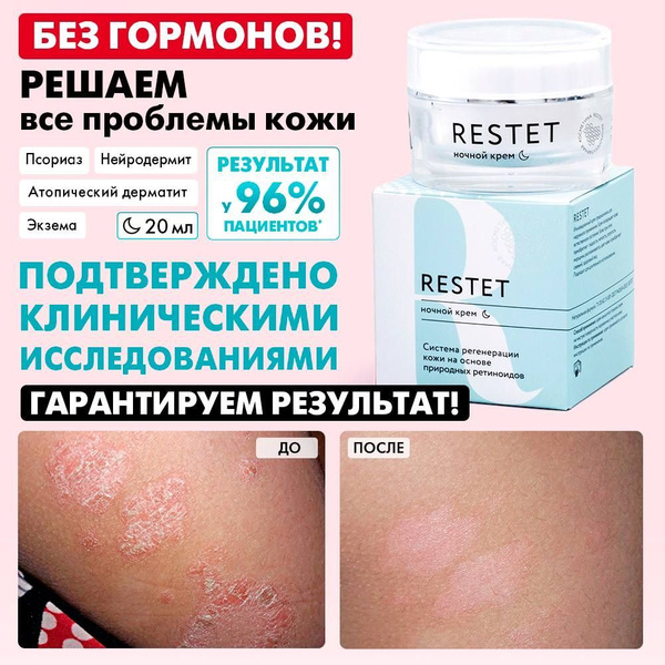 Ночной крем от псориаза Restet, мазь от псориаза, атопического ...
