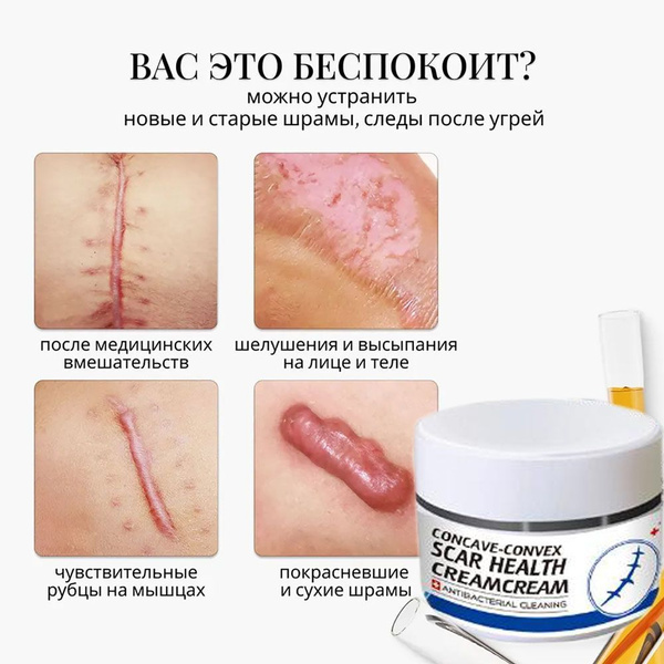 Крем-гель от шрамов, рубцов, растяжек, травм и пигментации, мазь от ...