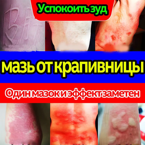 мазь от крапивницы,Устранение зуда,Восстановление кожи.1 коробка/20 г ...