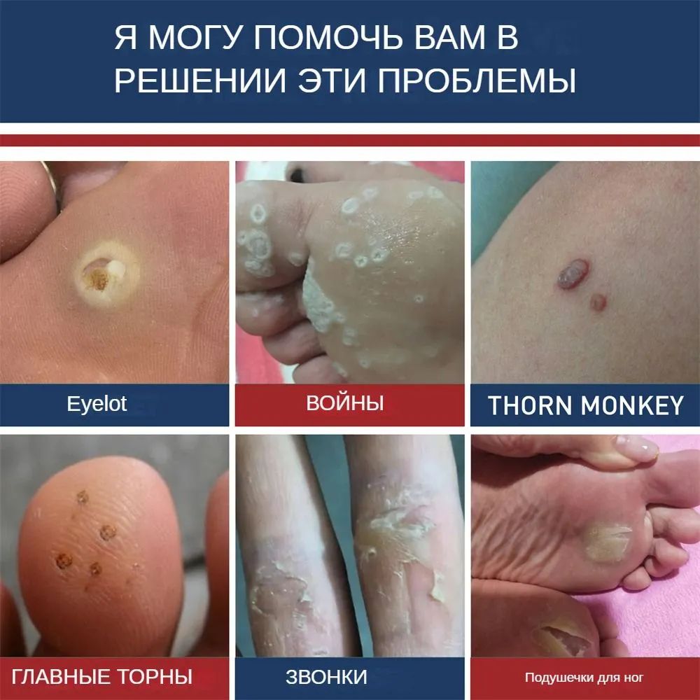Мазь от грибка ногтей и бородавок, эффективное средство для лечения ко(图1)
