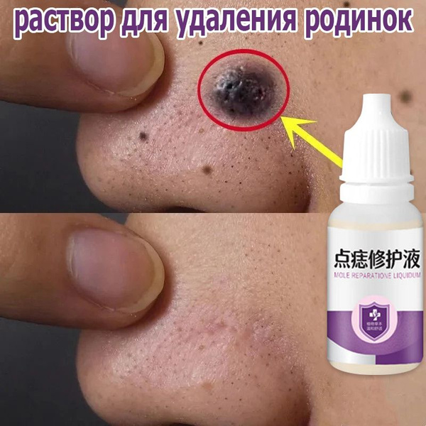 Жидкость для удаления родинок, используется для удаления папиллом ...