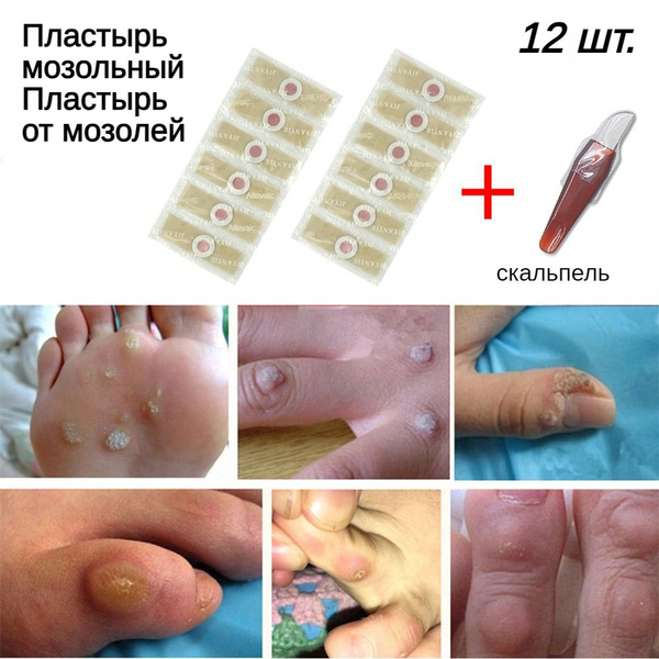 Пластырь от шипицы, натоптышей, сухих мозолей, бородавок 12 шт купить ...