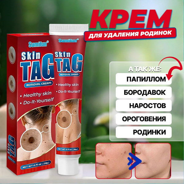 Крем средство от папиллом и бородавок / Средство гель от прыщей 20 мл ...