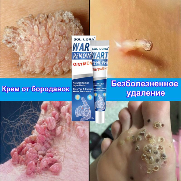 Мазь от бородавок / 60г, Безопасное и безболезненное полное удаление ...