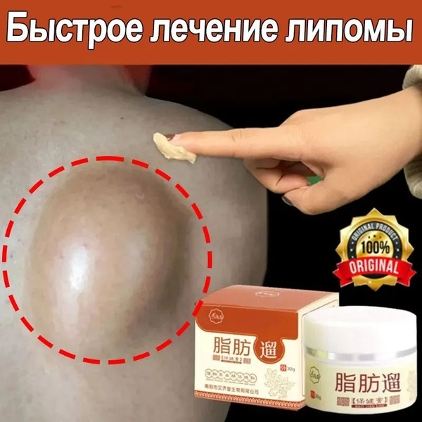 Липома удаляет крем, быстро удаляет подкожные жировые опухоли, показан ...