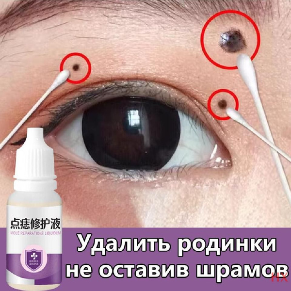 Крем для удаления родинок 10 мл от пятен черных родинок и бородавок ...