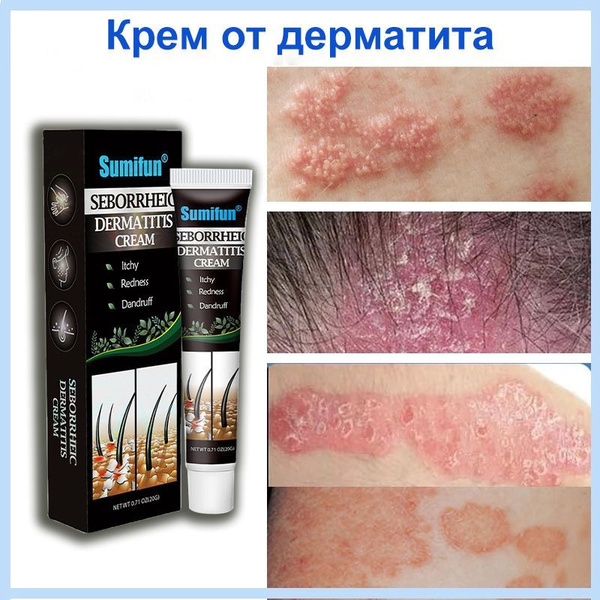Характеристики Крем от дерматита, для лечения себорейного дерматита ...