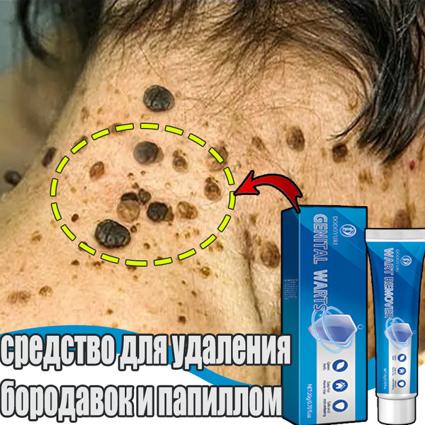 DODOYURI / Мазь от бородавок, Крем средство для удаления бородавок ...