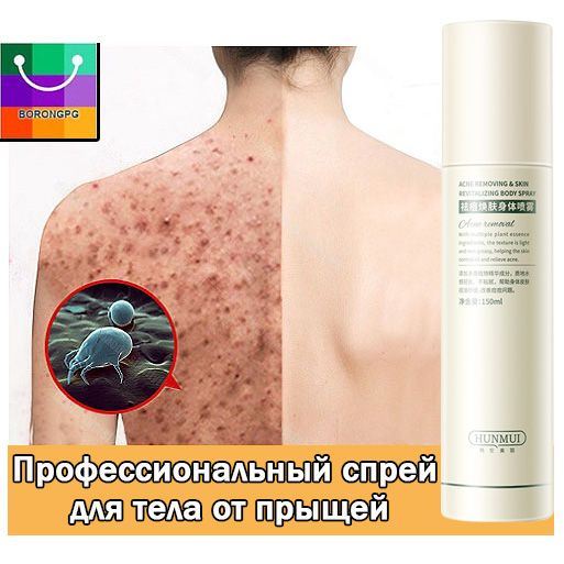 Сыворотка-спрей для тела AcneFree ,от прыщей акне и воспалений,150мл