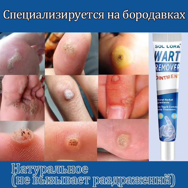 Средство от папиллом и бородавок, для удаления бородавок папиллом ...