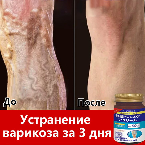 крем от варикозного расширения вен 50 г снимает боль улучшает ...