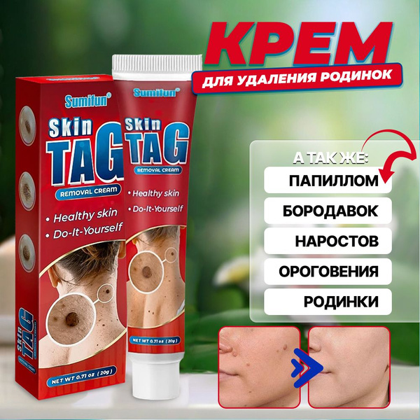 Крем средство от папиллом и бородавок Средство гель от прыщей 20 мл. g ...
