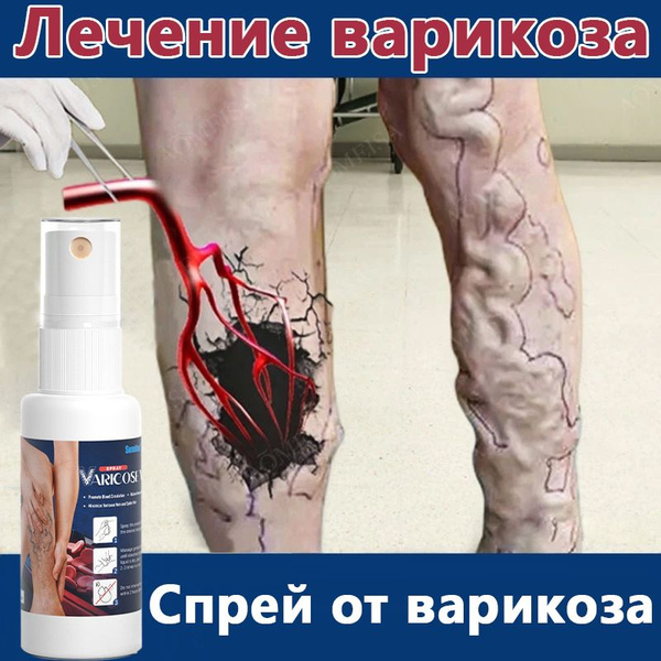 для ног и вен,Спрей от варикоза, от отёчности, Гель от варикозного ...