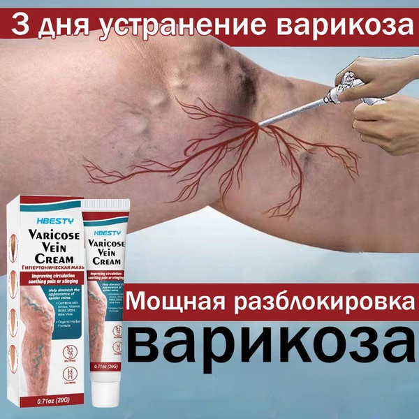 Гель от варикоза / охлаждающий крем для ног, Эффективен при лечении ...