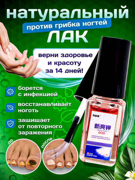 Средство от грибка ногтей на ногах и руках, масло от грибка ногтей на ...