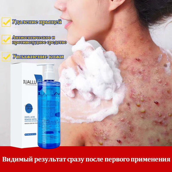 Гель для душа от прыщей, Глубоко очищает кожу тела, Быстро от клещей ...