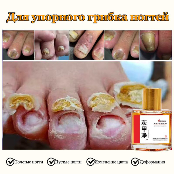 Мазь от грибка ногтей на ногах, для ногтей и кутикулы, борьба с ...