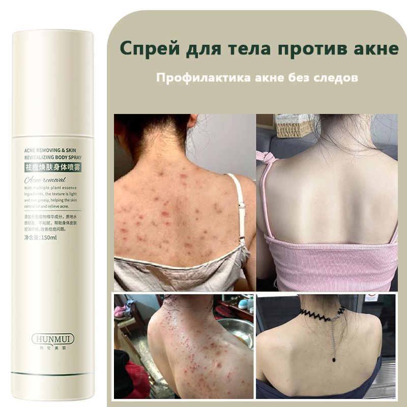 Универсальный спрей от угрей и прыщей, 100мл для тела Acne Free ,прыщей акне и воспалений, для ухода за кожей