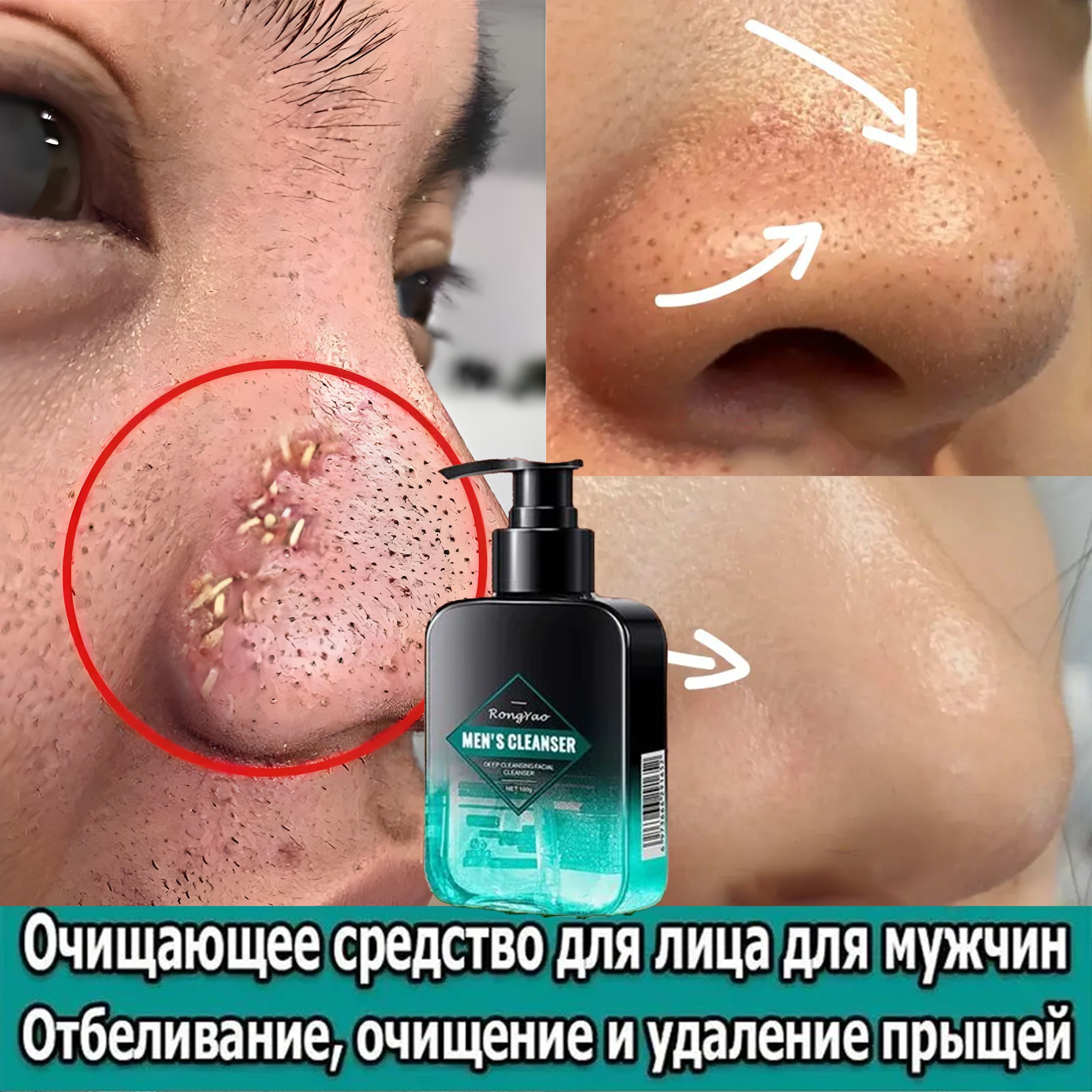 Гельмужскойдляумыванияотпрыщейичерныхточек160гПодходитдляжирнойипроблемнойкожидозаторомсаминокислотами