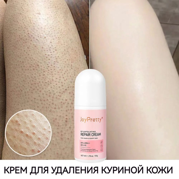 Крем для тела, Средство для удаления куриной кожи, Лосьон от кератоза ...