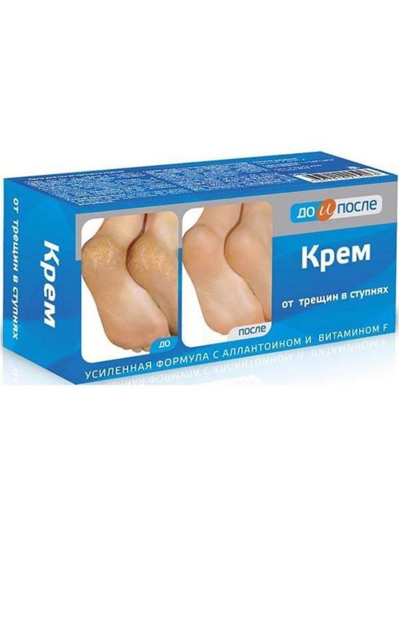 Помощь от трещин на пятках. Помощь от трещин на пятках