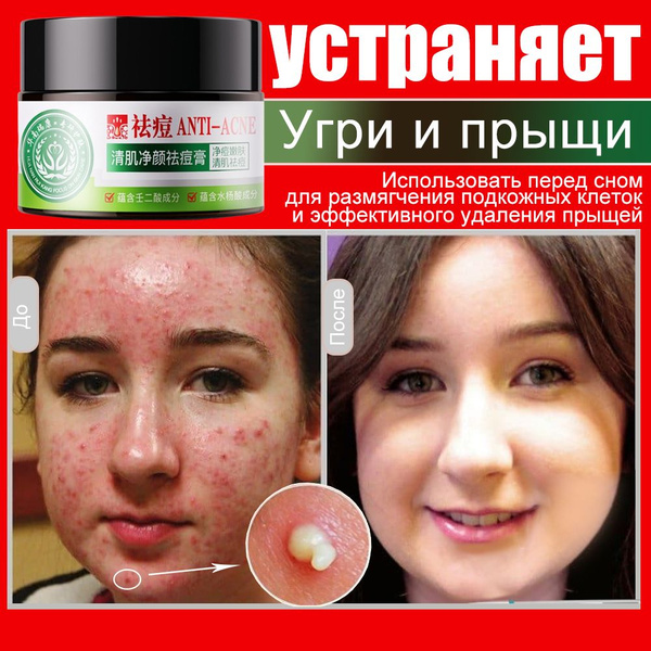 Цинковый крем,Гель от прыщей, прыщей, акне, постакне для наружного ...