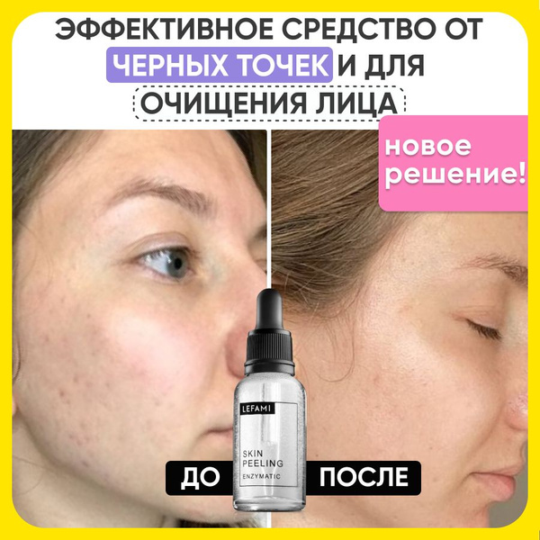Пилинг для лица отшелушивающий от черных точек - купить с доставкой по ...