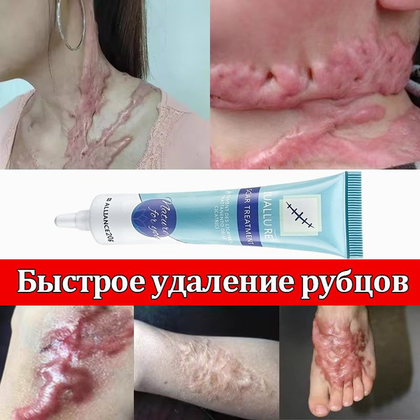 Крем гель от рубцов, для лица и тела, для ухода за кожей после удаления ...