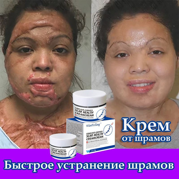 Заживляющий крем от шрамов, растяжки, ожогов, постакне 30 г купить на ...