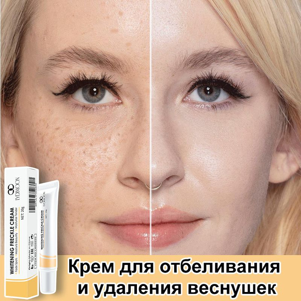 Крем для отбеливания и удаления веснушек, пигментации и пигментных ...