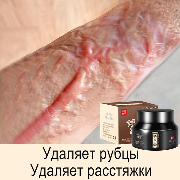 Крем для удаления шрамов.рубцов, растяжек для беременных и пигментации ...