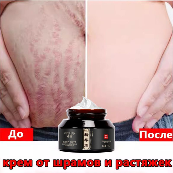 Средство от растяжек купить на OZON по низкой цене (1771955035)
