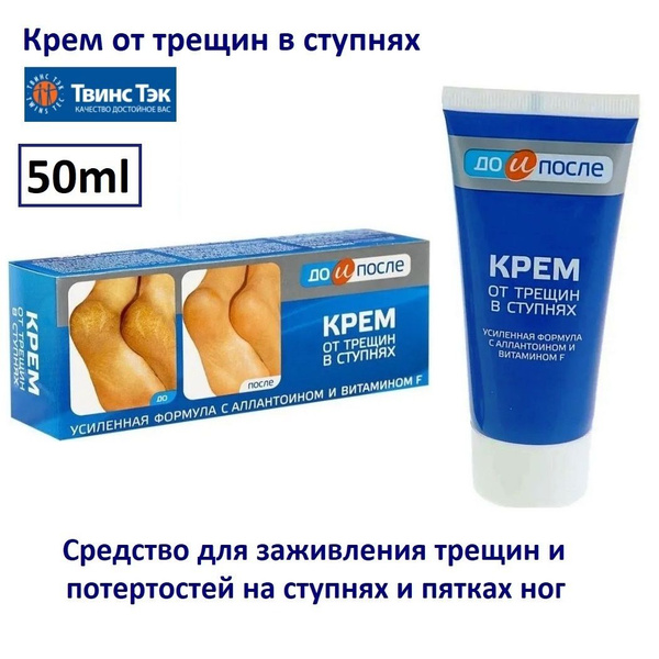 Крем от трещин в ступнях До и После, 50мл купить на OZON по низкой цене ...