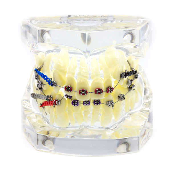 Челюсть стоматологическая, модель челюсти с металлическими брекетами ...