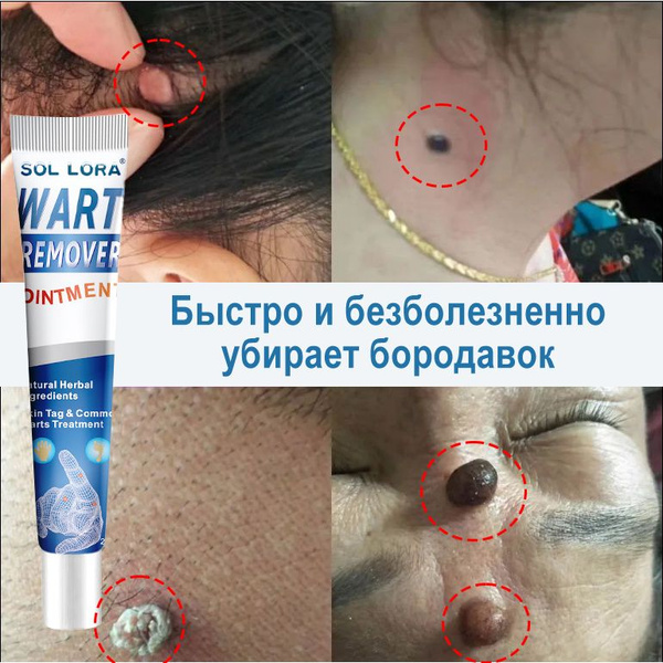 Характеристики Крем от папиллом и бородавок/Средство для удаления ...