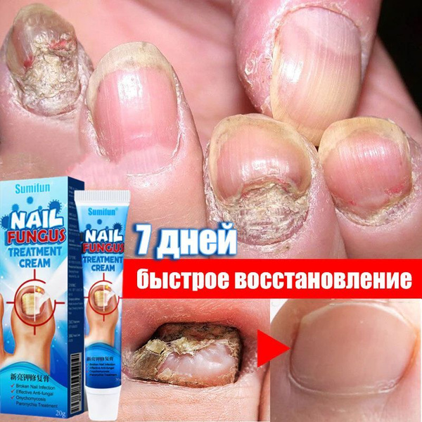 Средство от грибка ногтей, для ног,уход за ногтями, борьба с ...