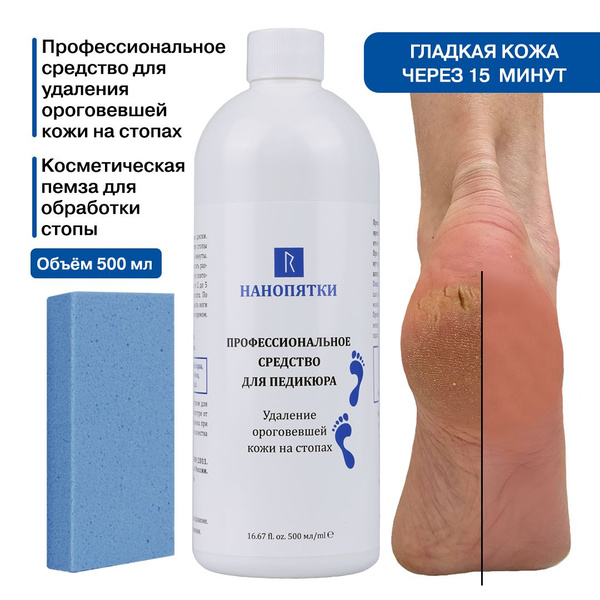 НАНОПЯТКИ Набор для ухода за кожей стоп № 36: Кератолитик для педикюра ...
