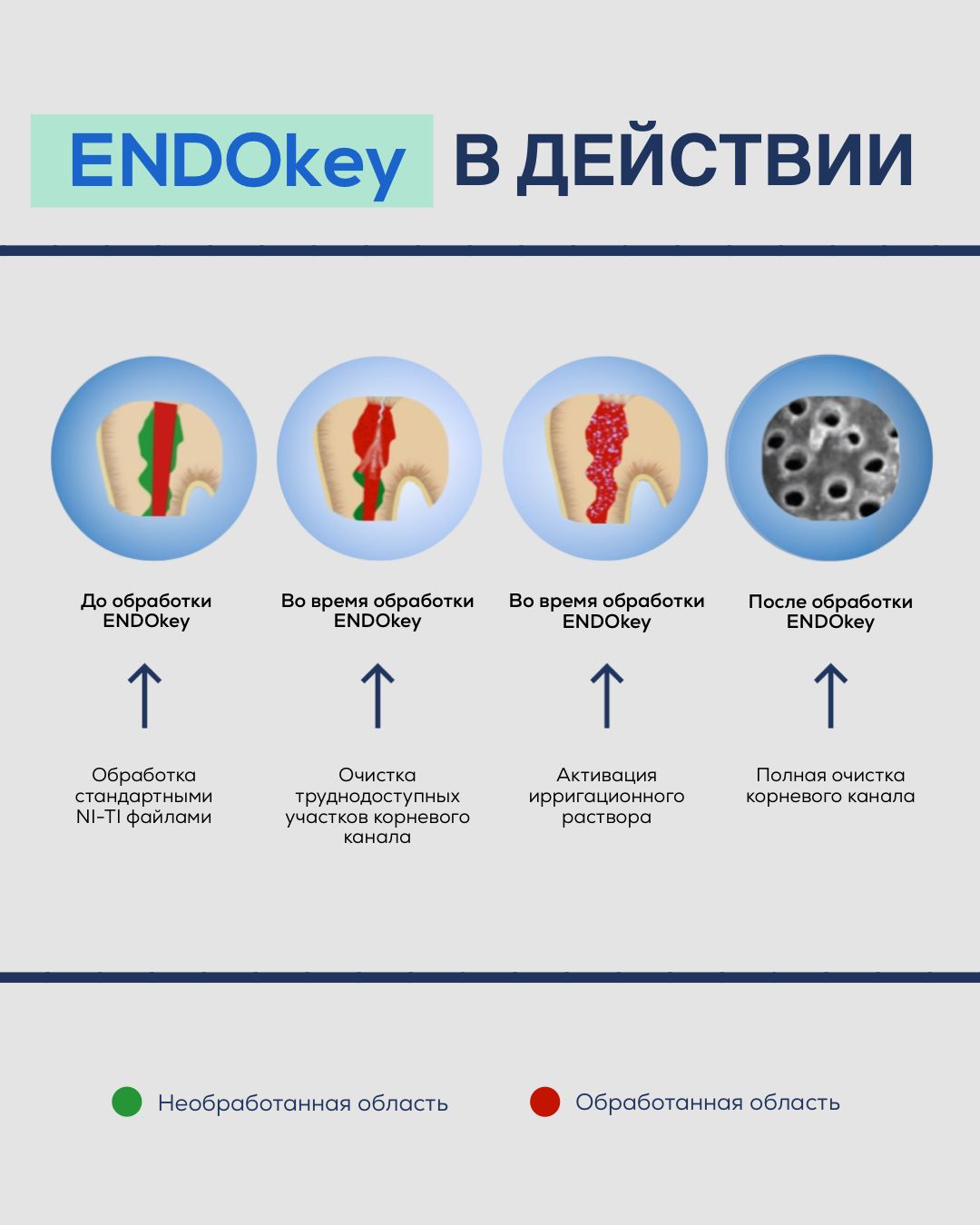 ENDOkey Инструмент стоматологический, 5шт(图1)