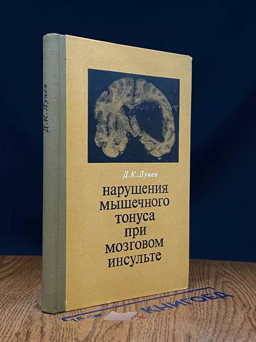 Нарушения мышечного тонуса при мозговом инсульте