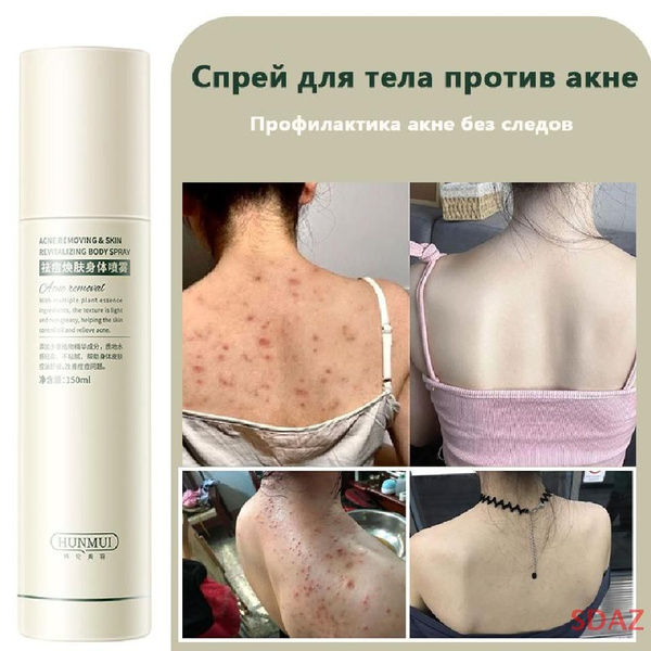 Универсальный спрей от угрей и прыщей, 100мл для тела Acne Free ,прыщей ...